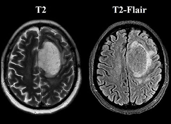 Радиология: случай анапластической астроцитомы
