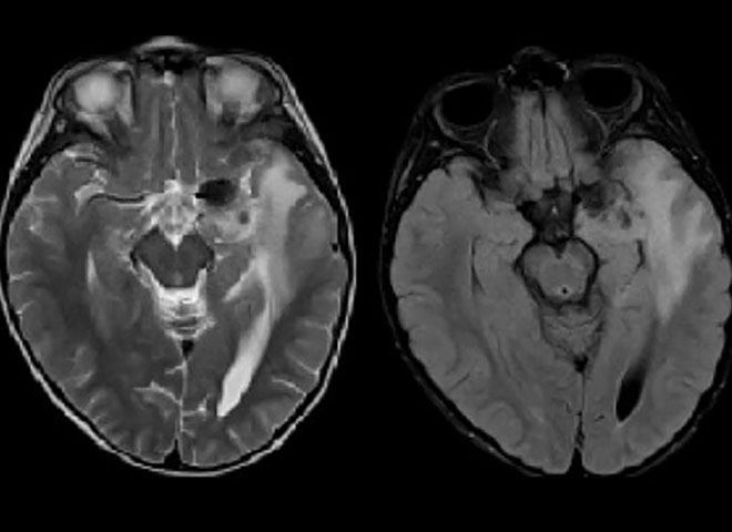 Радиология: случай солитарной фиброзной опухоли