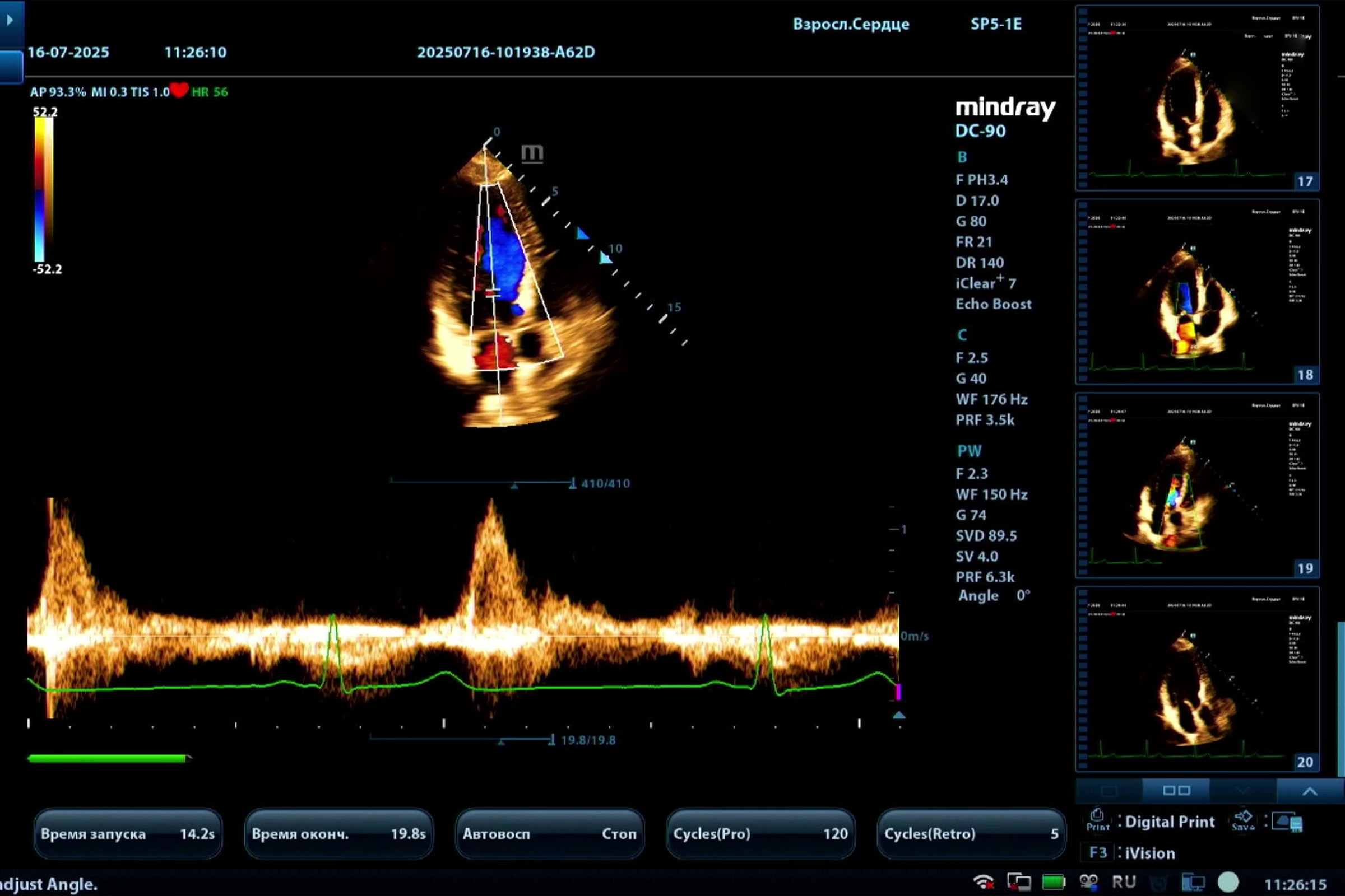 ЭхоКГ у пациентки с грудными имплантами: мастер-класс на Mindray DC-90