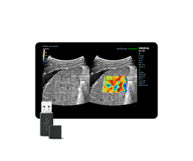 STE (Sound Touch Elastography)